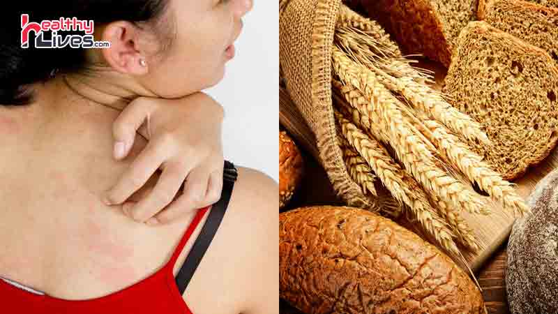 Alergia al gluten