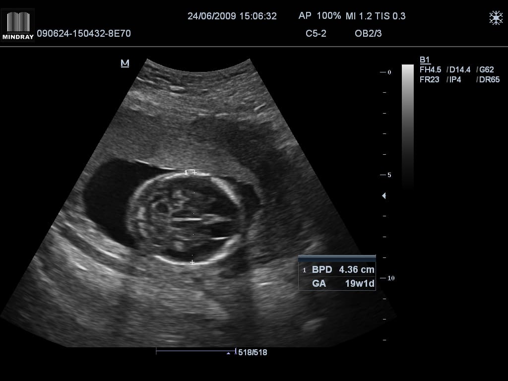 17 недель развитие. Снимок УЗИ на 19 неделе беременности. Малыш на 19 неделе беременности УЗИ. УЗИ ребенка на 19 неделе беременности на УЗИ. 19 Недель беременности фото плода на УЗИ.