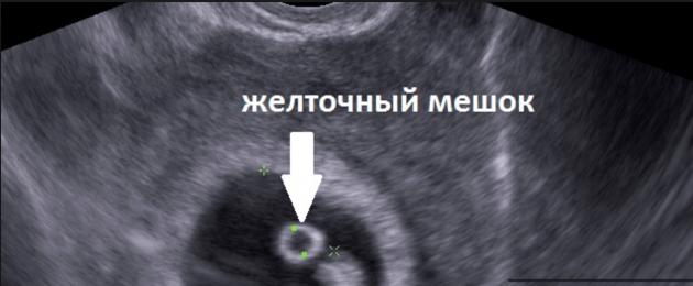 Почему не видно эмбрион. УЗИ 6 недель беременности желточный мешок. Плодное яйцо с эмбрионом и желточным мешком. Плодное яйцо и желточный мешок. Плодное яйцо 8,6мм а жеточный мешок 1.3 мм.