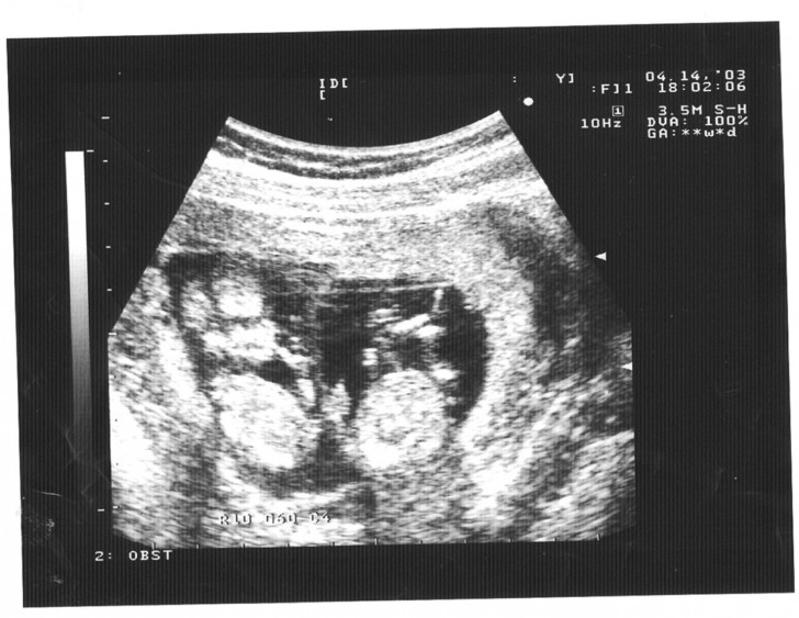 Беременность 5-6 недель. первые признаки, развитие малыша. узи. размеры плодного яйца