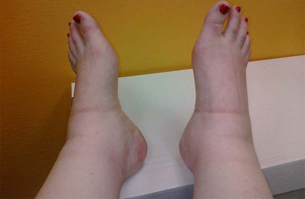 Венозные заболевания – отеки лодыжек и ног поддаются лечению