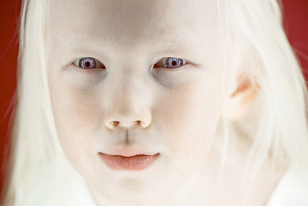 Aniyah albino