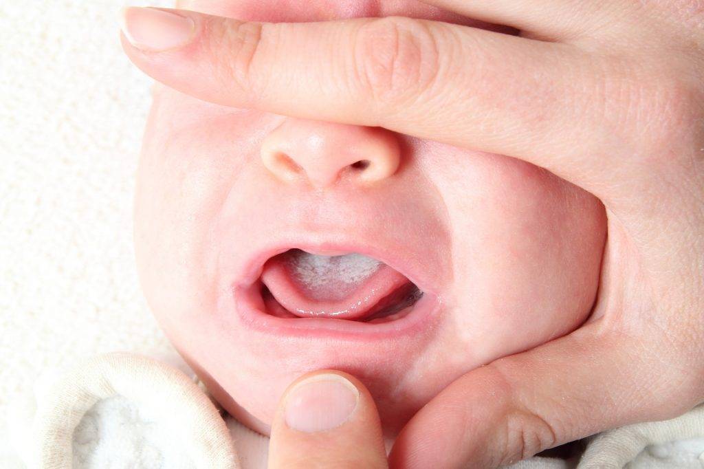У ребенка на губах белые пузырьки. причины мозолей на губах у детей