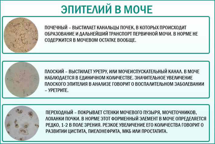 Повышенный эпителий в моче у мужчин. Почечный эпителий в моче норма. Эпителий плоский в моче. Клетки почечного эпителия в моче. Плоский переходный и почечный эпителий в моче.