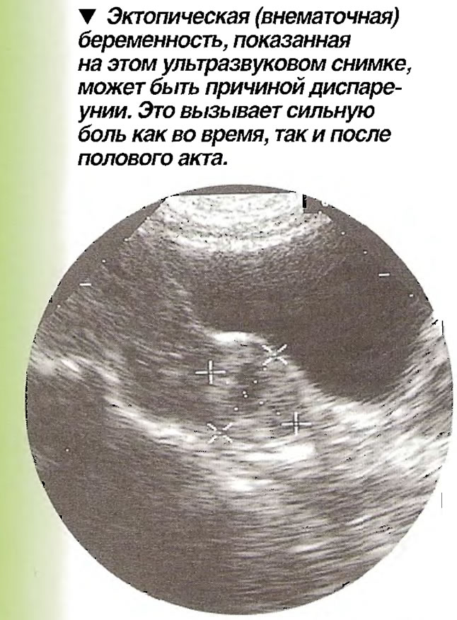 Можно ли внематочную беременность. Внематочная беременность. Внематочнаябкременность. Эктоп иче Кая беременность.