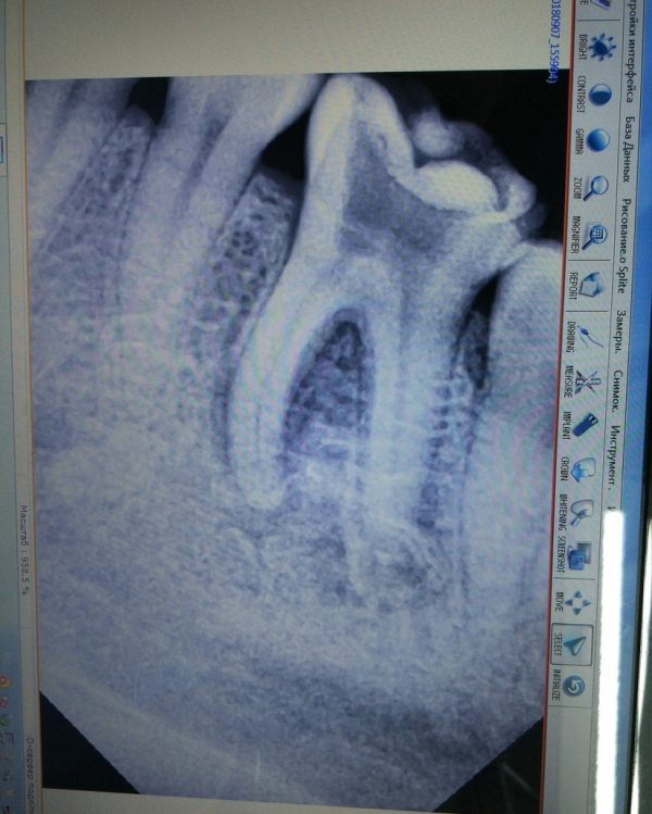 Рентген: снимок зубов - стоматологическая клиника элитдентал м