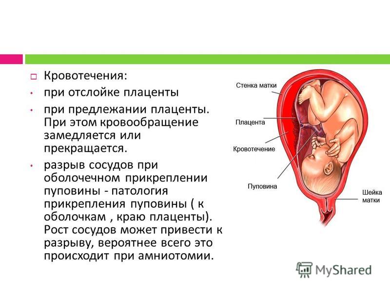 Отслойка плаценты карта вызова