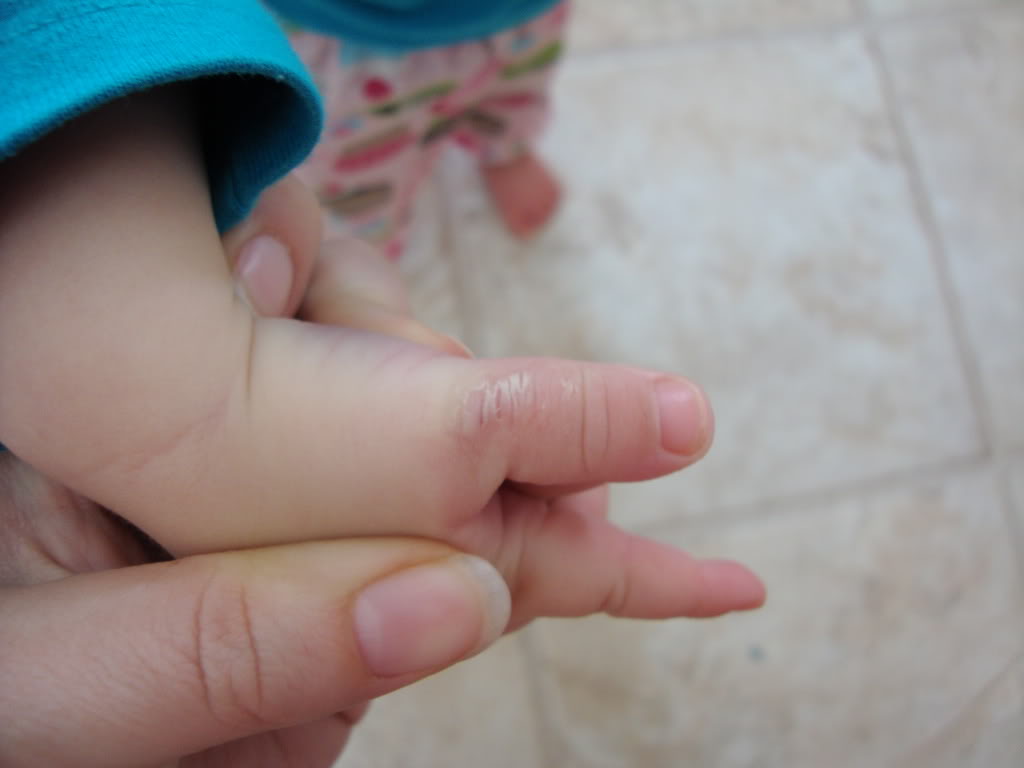 Щелкающий палец: причины, признаки, профилактика — онлайн-диагностика