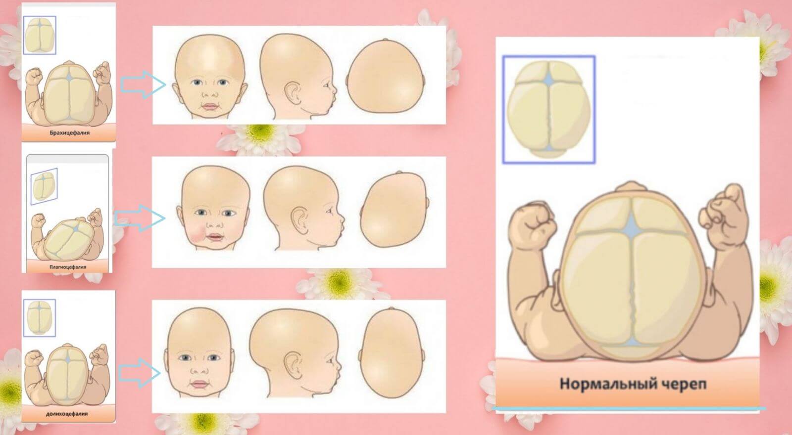 если у ребенка голова больше чем грудь фото 25