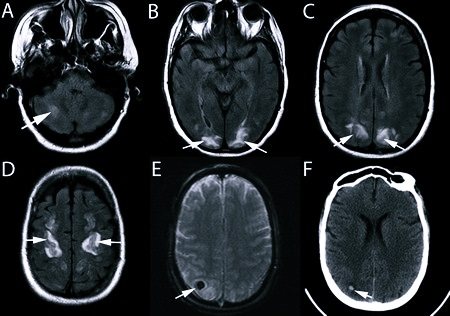 Лечение энцефалопатии головного мозга в москве