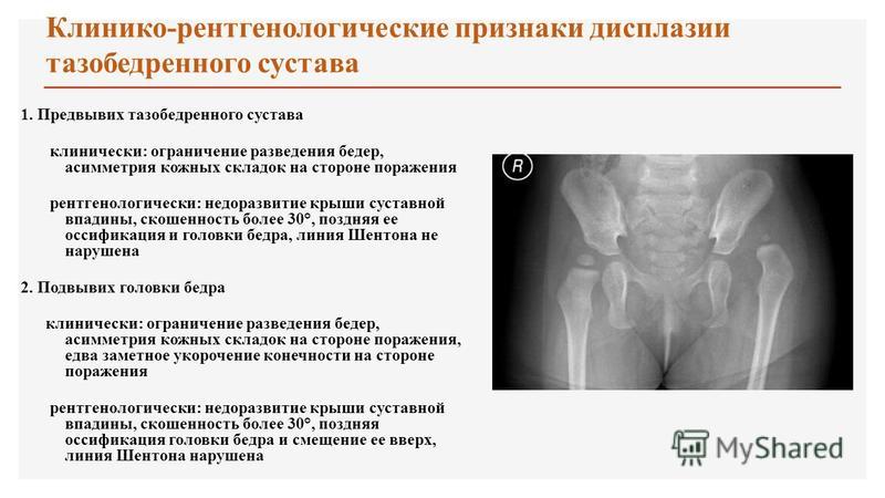 Рентгенография тазобедренного сустава в 2 х проекциях в клинике цэлт, в москве