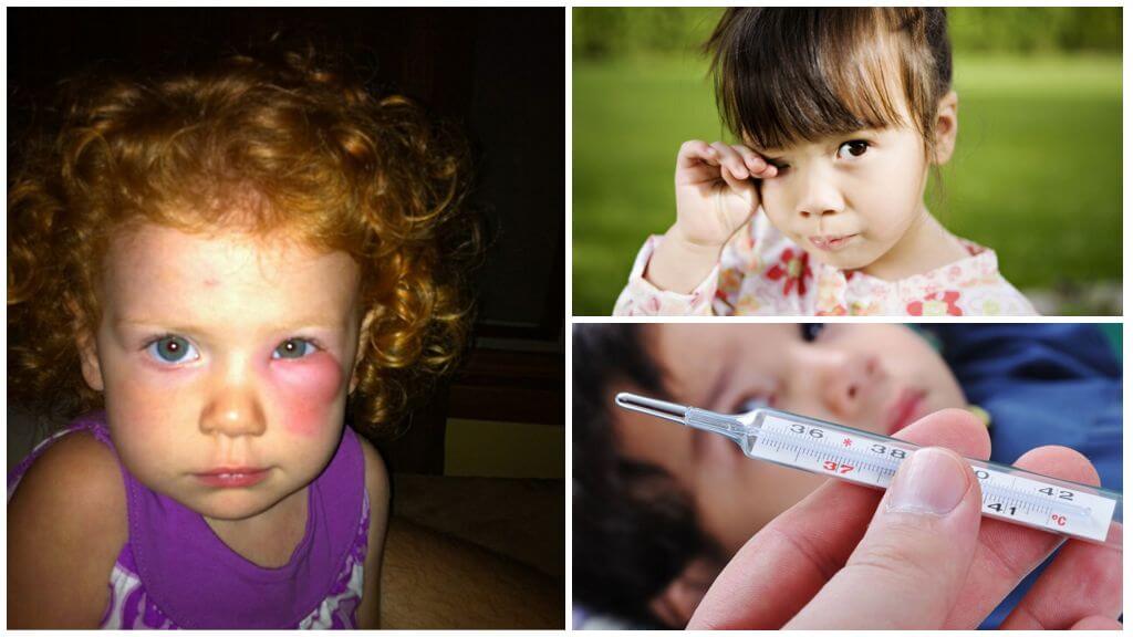 Глаза после прививки. Аллергические укусы комаров у детей.