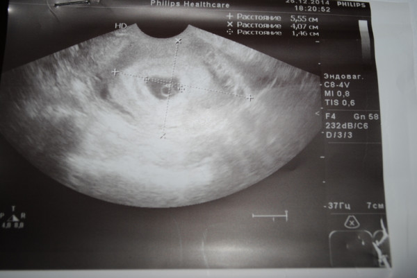 Предполагаемая дата зачатия. акушерский срок беременности.