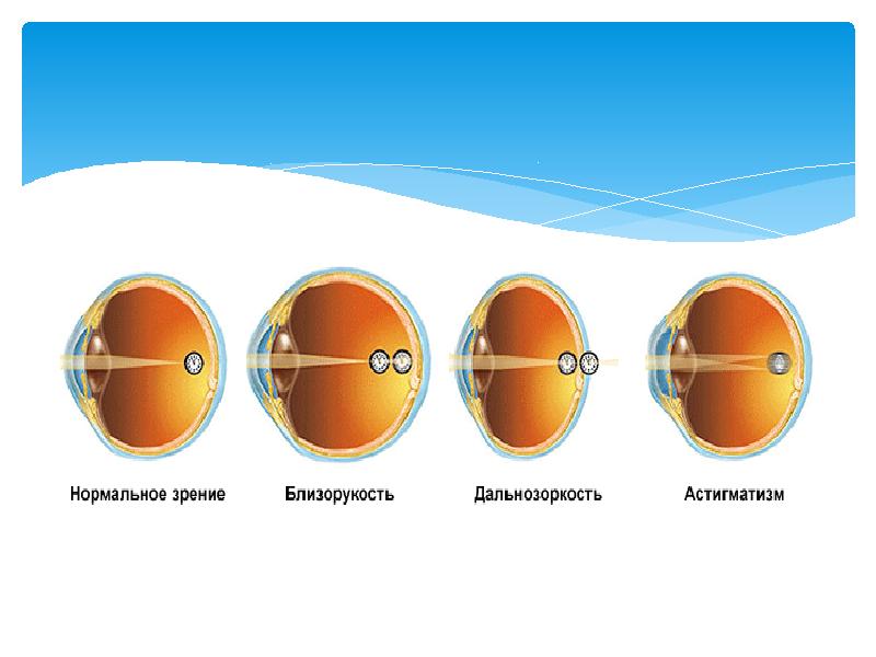 Как видит человек с астигматизмом и близорукостью картинки