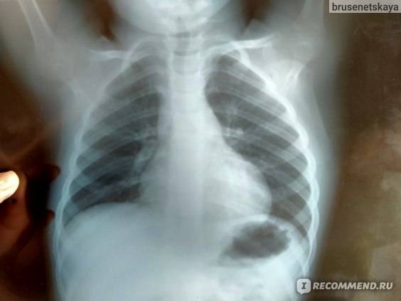Флюорография и рентген при грудном вскармливании: потенциальные риски