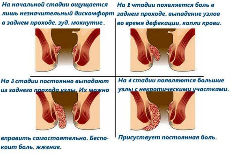 Геморрой при беременности: причины, симптомы и лечение геморроя у беременных - yod.ua
