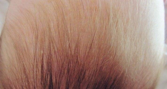 Себорейное выпадение волос: причины, лечение, профилактика - клиника «доктор волос»