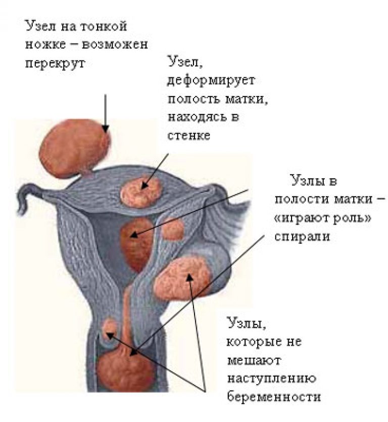 Узелок в матке. Миома на задней стенке матки.