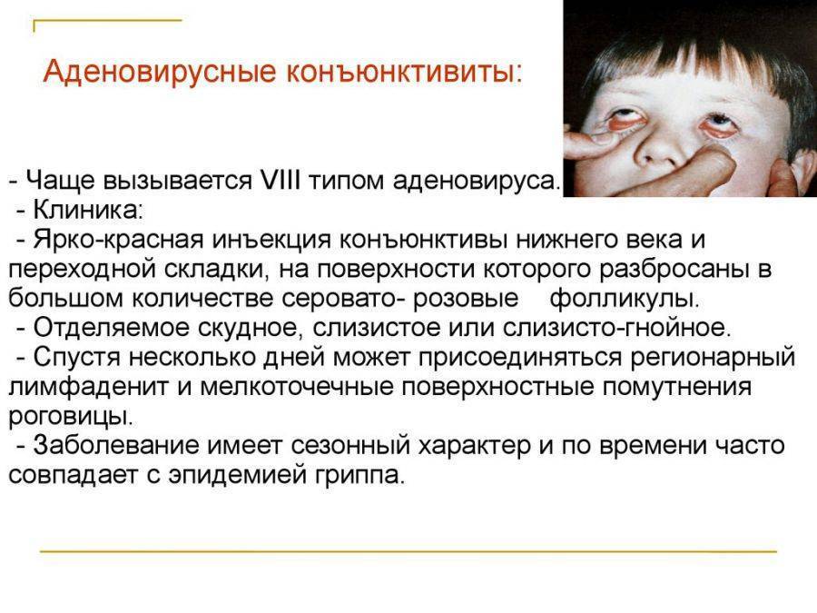 Постоянный конъюнктивит у ребенка: причины - энциклопедия ochkov.net