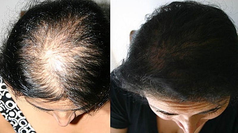 Почему выпадают волосы и как остановить выпадение волос – советы врача-трихолога | портал 1nep.ru