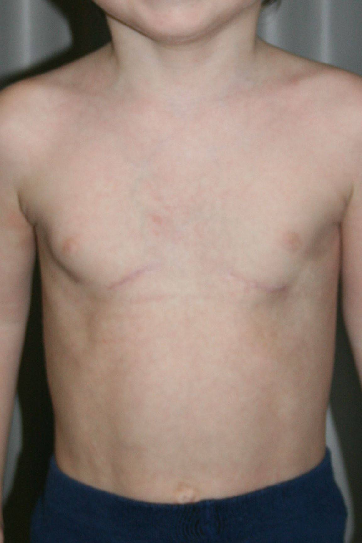 воронкообразная грудь у мужчин фото 116
