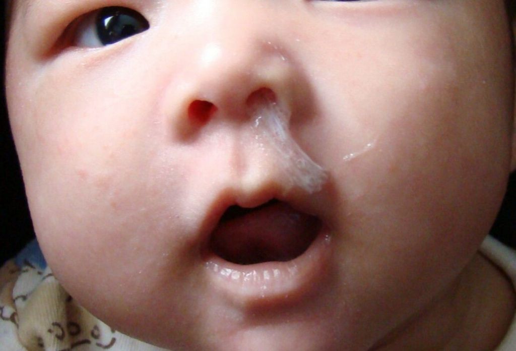 Что делать, если заложен нос у новорожденного?