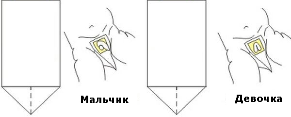 Как прикрепить девочке мочеприемник фото