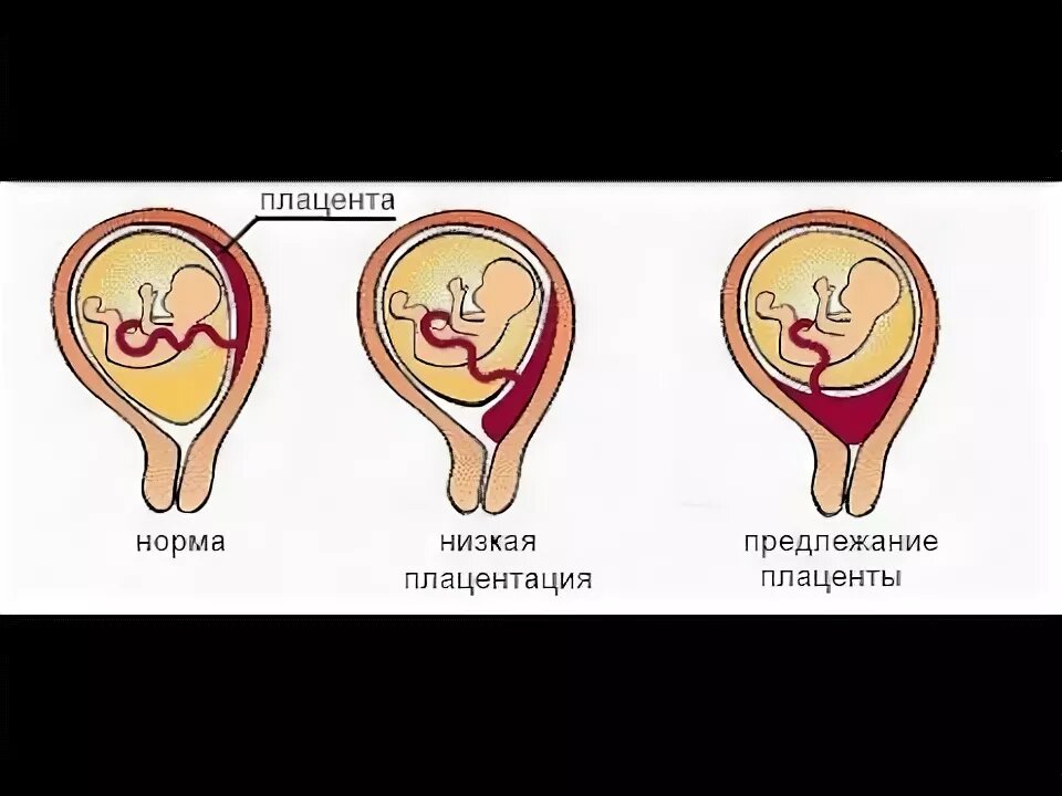 Полное предлежание при беременности. Краевое предлежание плаценты и норма. Полное и частичное предлежание плаценты. Низкое предлежание плаценты при беременности 15 недель. Центральное предлежание хориона.