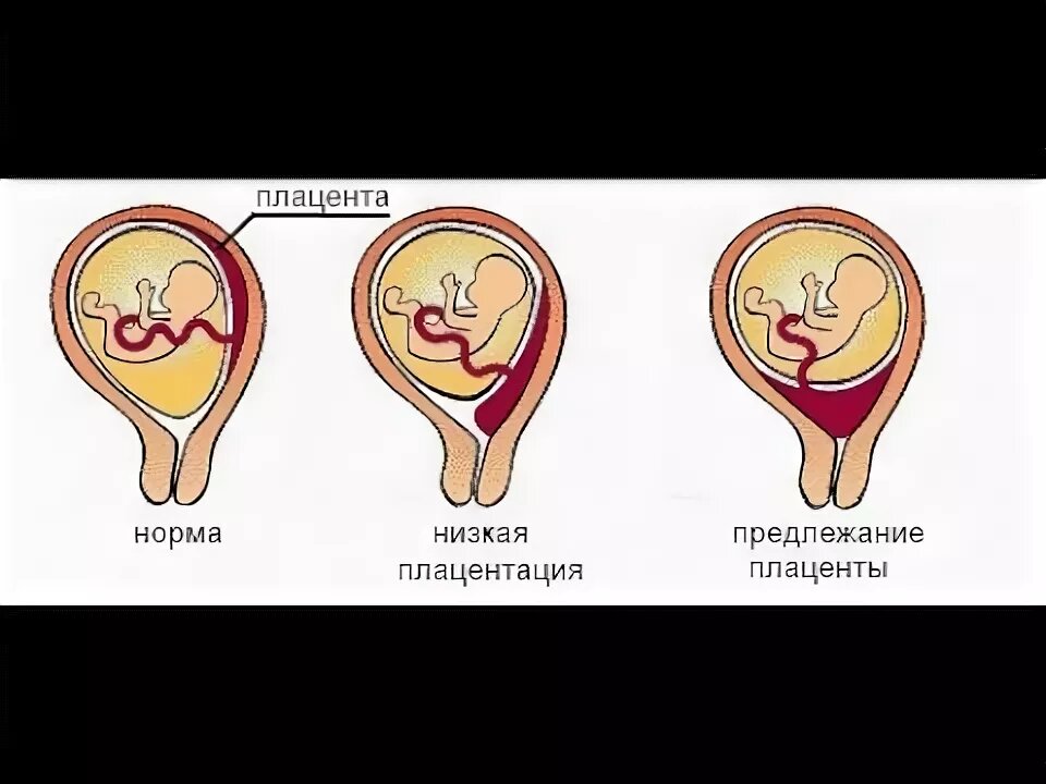 Предлежание плаценты картинки