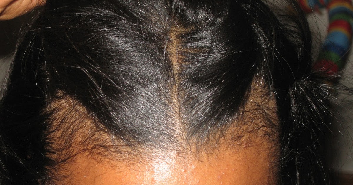 Что делать, если после родов выпадают волосы. почему выпадают волосы. врач трихолог