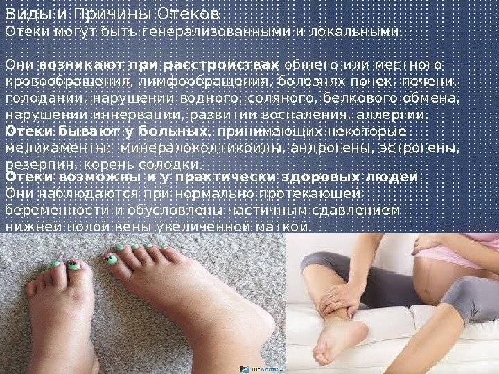 Причины и симптомы отеков ног при беременности, как снять и профилактика