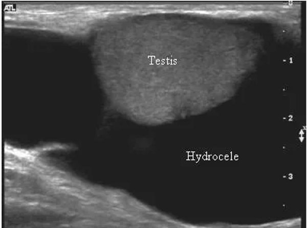 Узи яичек у ребенка. Жидкость в оболочках яичка на УЗИ. Водянка оболочек яичка УЗИ. УЗИ органов мошонки гидроцеле.
