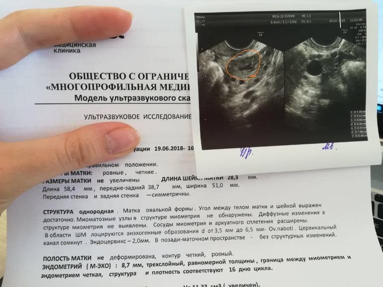 Жёлтое тело на узи: какие размеры должны быть