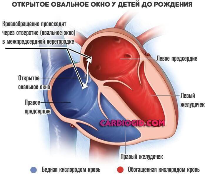 Если у новорождённого открытое овальное окно в сердце — разъясняет детский кардиолог