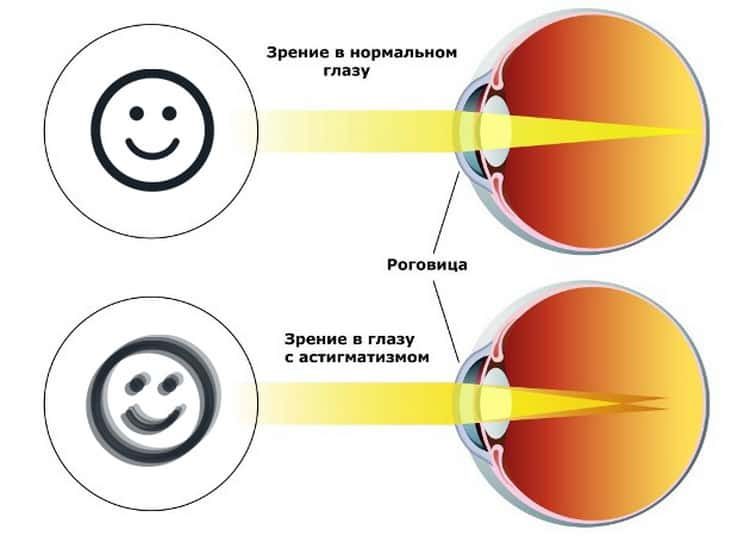 Детский офтальмолог о дальнозоркости у детей и методах борьбы с нею