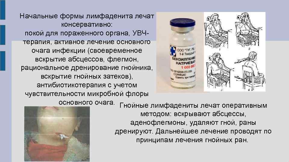 Острый серозный лимфаденит - симптомы болезни, профилактика и лечение острого серозного лимфаденита, причины заболевания и его диагностика на eurolab