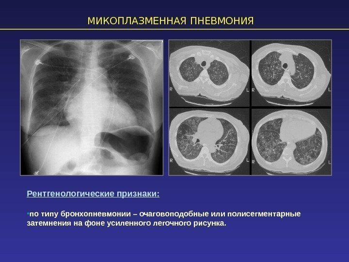 Об особенностях клинической картины и подходах к лечению микоплазменной пневмонии у детей расскажет врач-педиатр