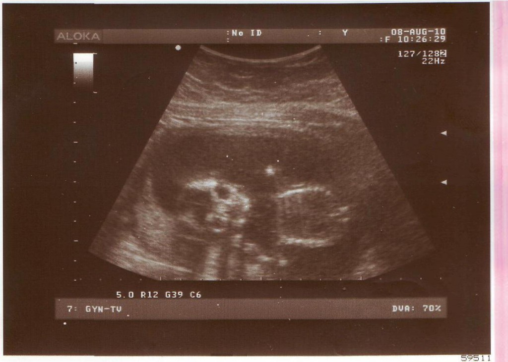 Тонус 8 недель. Гипертонус матки при беременности 2 триместр УЗИ. Гипертонус матки на УЗИ при беременности. Тонус матки при беременности 1 триместр УЗИ. При тонусе матки при беременности.