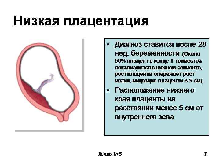 Предлежание плаценты — большая медицинская энциклопедия