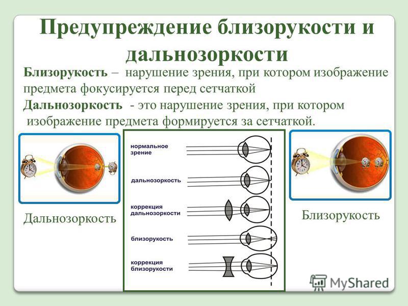 Причины возникновения дальнозоркости. Причины и профилактика близорукости и дальнозоркости. Зрительный анализатор дальнозоркость и близорукость. Профилактика близорукости и дальнозоркости. Таблица нарушение зрения близорукость дальнозоркость.