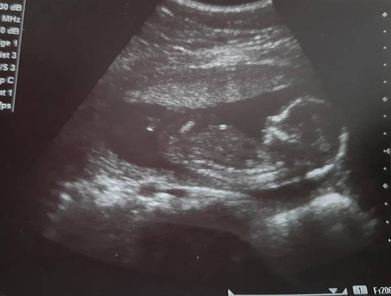 Как выглядит зародыш в 16 недель беременности фото