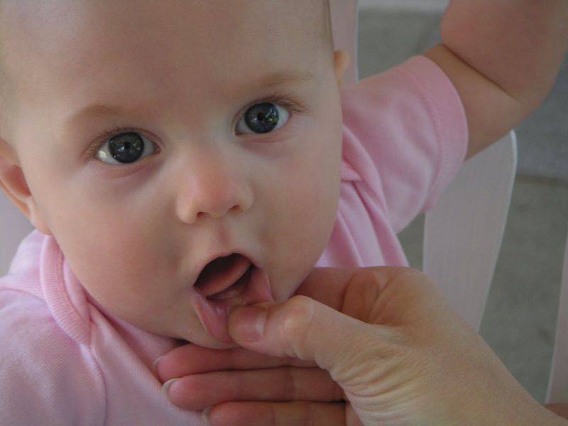 Затрудненное прорезывание зубов у детей