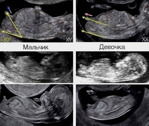 Узи на 12 неделе беременности (38 фото): размер плода при скрининг-узи, нормы и расшифровка, можно ли определить пол ребенка, что показывает