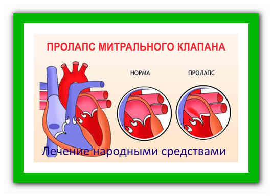 Пролапсы клапанов сердца. диагностика и лечение