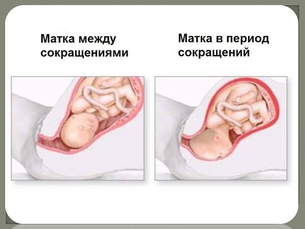 Тонус матки при беременности в 3 семестре : причины, симптоматика, что делать, госпитализация, опасность