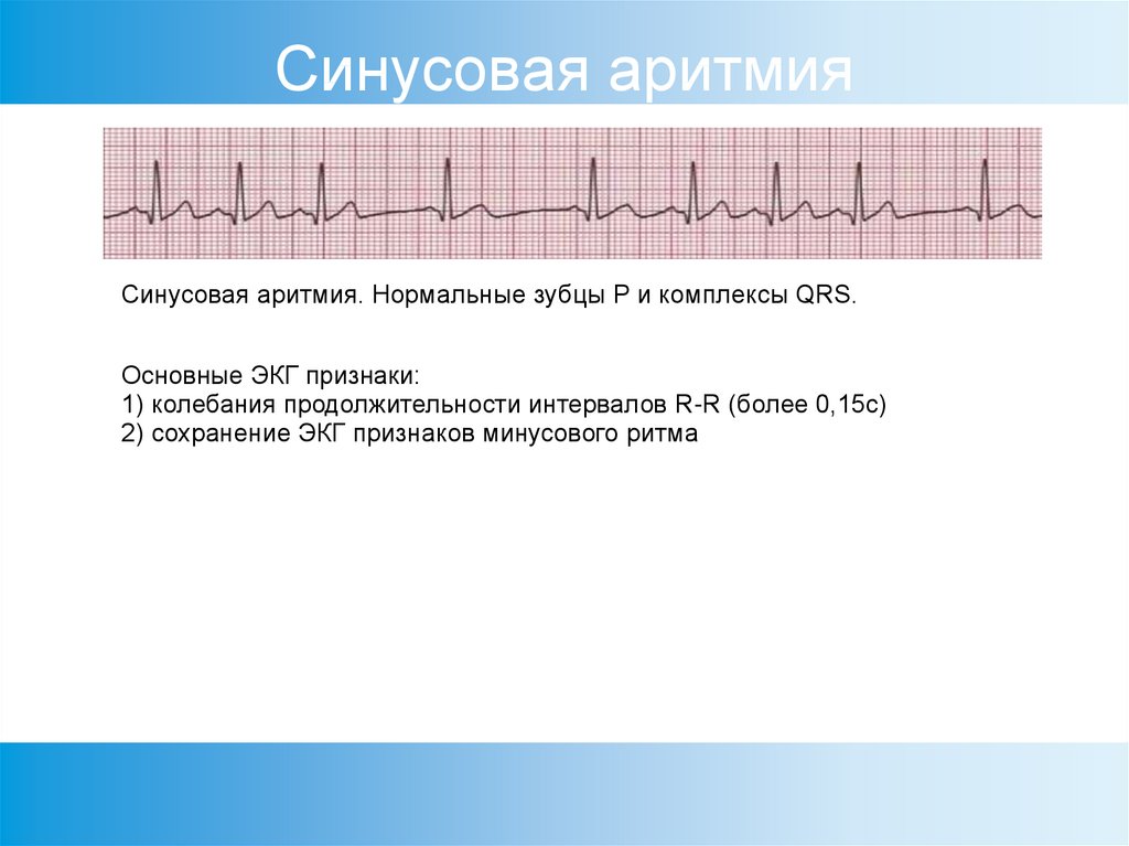 Нарушения ритма (аритмии) и проводимости (блокады) сердца. диагностика и лечениеаритмия сердца. причины, диагностика и лечение сердечной аритмии