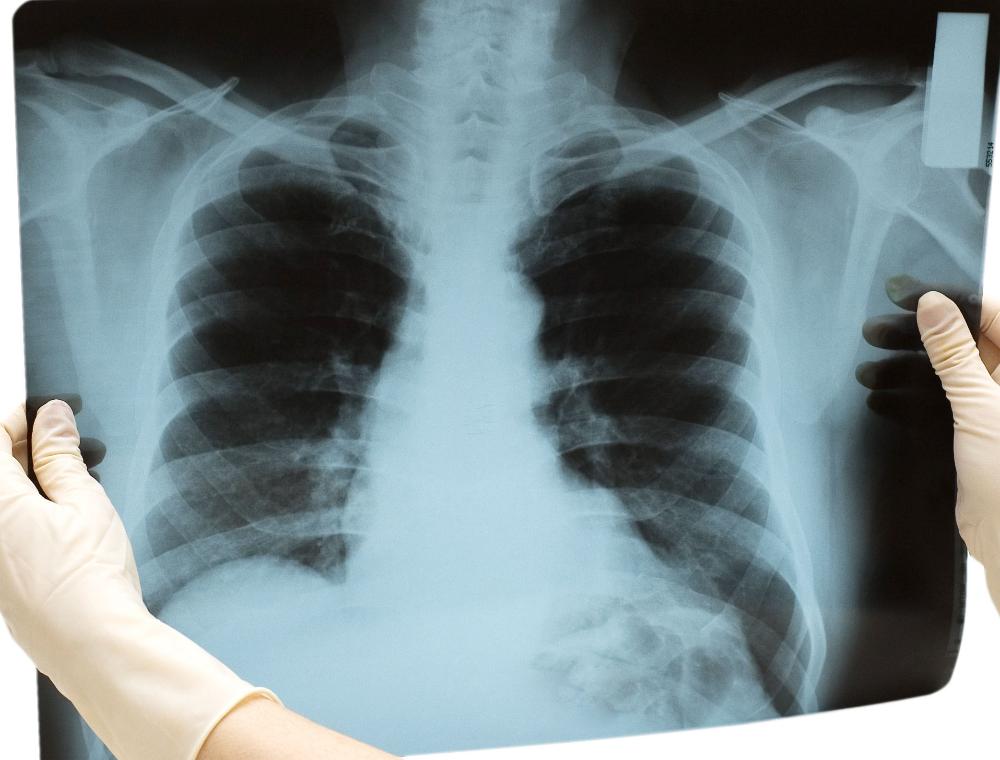 Рентген и гв - грудное вскармливание - страна мам