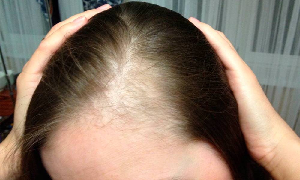 Почему после родов выпадают волосы и как это остановить