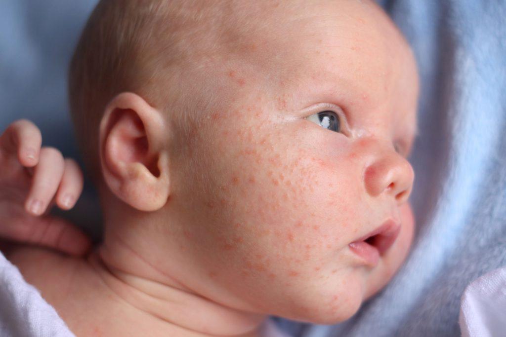 Пищевая аллергия на щеках у новорожденных: чем лечить крапивницу
