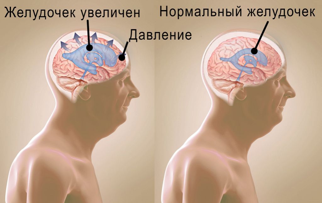 Последствия гидроцефалии головного мозга